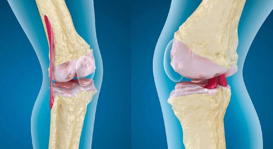 A csípőízület 2. fokozatának coxarthrosis kezelése, A csípőízület kopása - Okok és tünetek